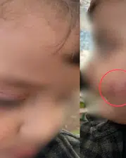 Diyarbakır’da kreş skandalı iddiası! 2 yaşındaki çocukta darp ve ısırık izleri