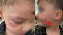 Diyarbakır’da kreş skandalı iddiası! 2 yaşındaki çocukta darp ve ısırık izleri