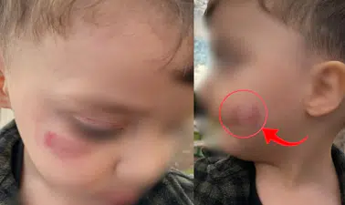 Diyarbakır’da kreş skandalı iddiası! 2 yaşındaki çocukta darp ve ısırık izleri