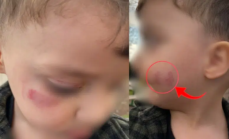 Diyarbakır’da kreş skandalı iddiası! 2 yaşındaki çocukta darp ve ısırık izleri